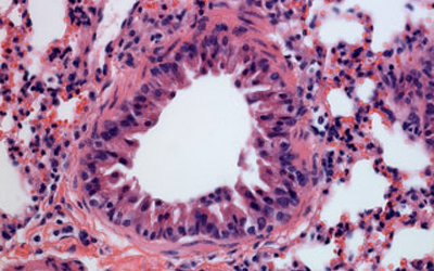 Cross section of a lung infected by the MERS virus